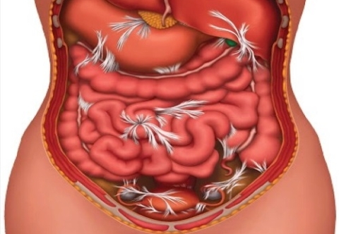 Biến chứng nguy hiểm thủng ổ loét dạ dày – tá tràng khi không được điều trị kịp thời